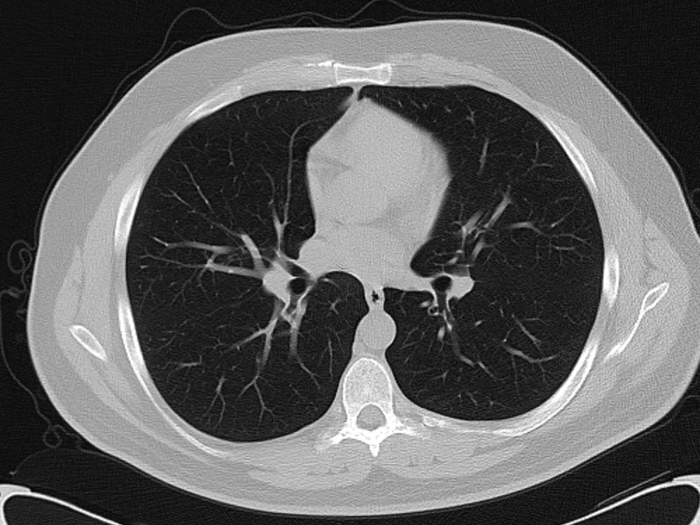 Axial chest CT scan in the lung window, with both lung fields outlined